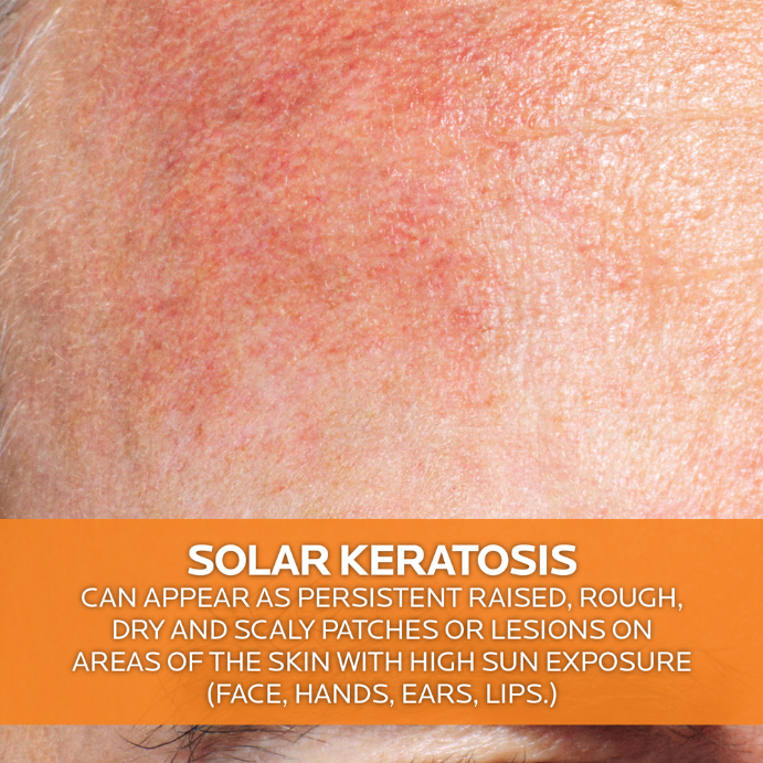 La Roche Posay Anthelios KA+ SPF50+ 50ml
