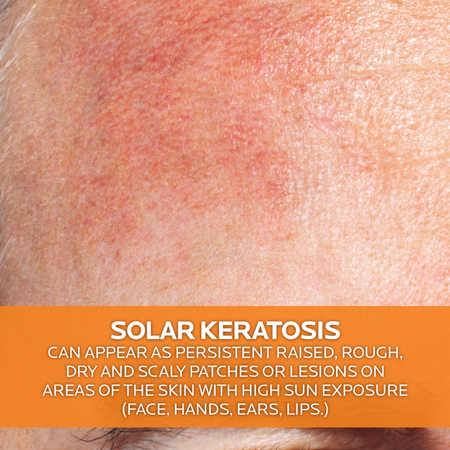 La Roche Posay Anthelios KA+ SPF50+ 50ml