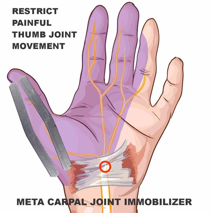 Bodyassist MCP Dual Splint Thumb Brace - One Size