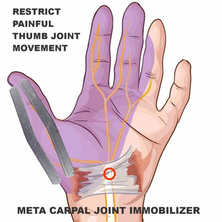 Bodyassist MCP Dual Splint Thumb Brace - One Size
