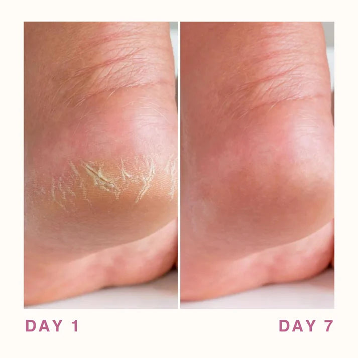 Dermelive 40% Urea Heel Cream 75g